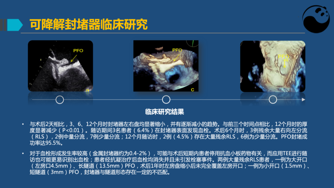 卵圆孔未闭(PFO)介入封堵技巧