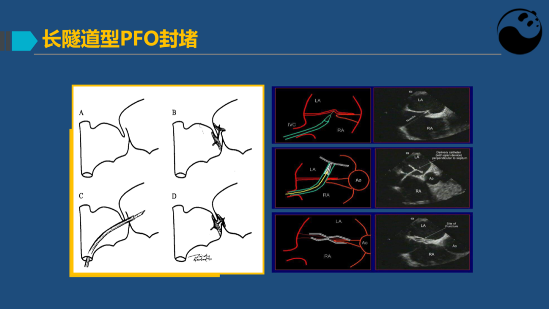 卵圆孔未闭(PFO)介入封堵技巧