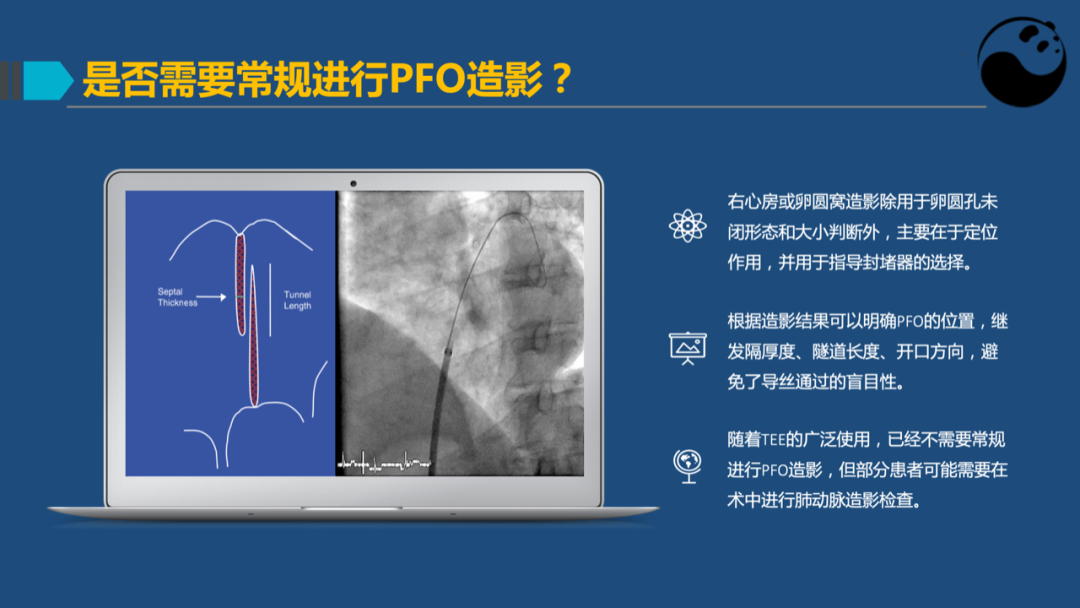 卵圆孔未闭(PFO)介入封堵技巧