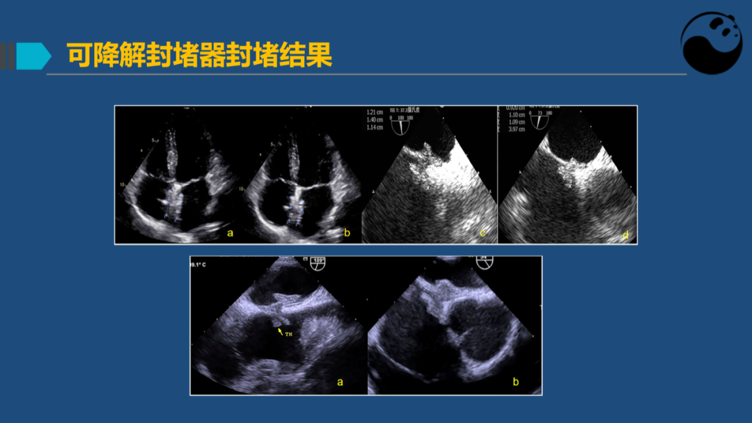 卵圆孔未闭(PFO)介入封堵技巧