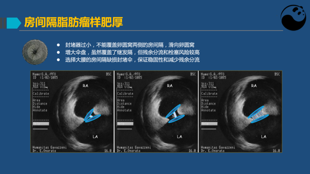 卵圆孔未闭(PFO)介入封堵技巧