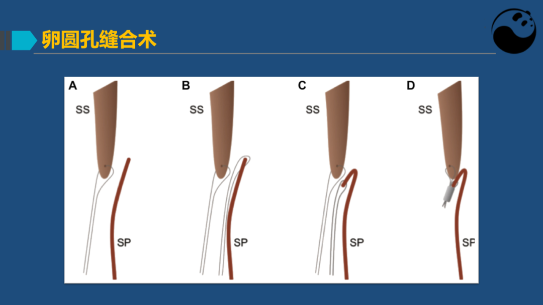 卵圆孔未闭(PFO)介入封堵技巧