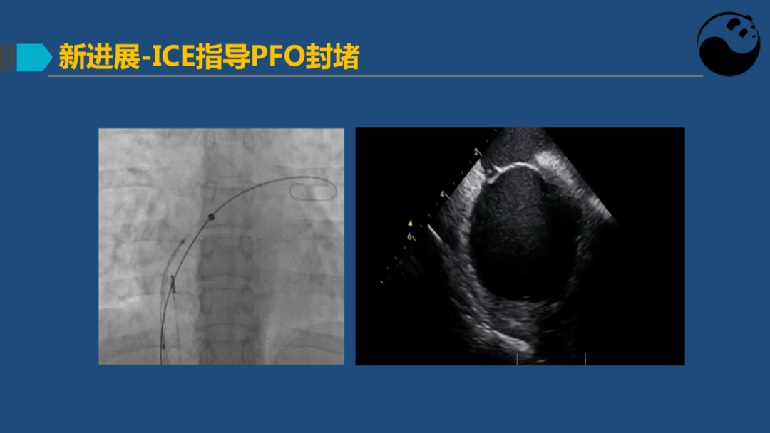 卵圆孔未闭(PFO)介入封堵技巧