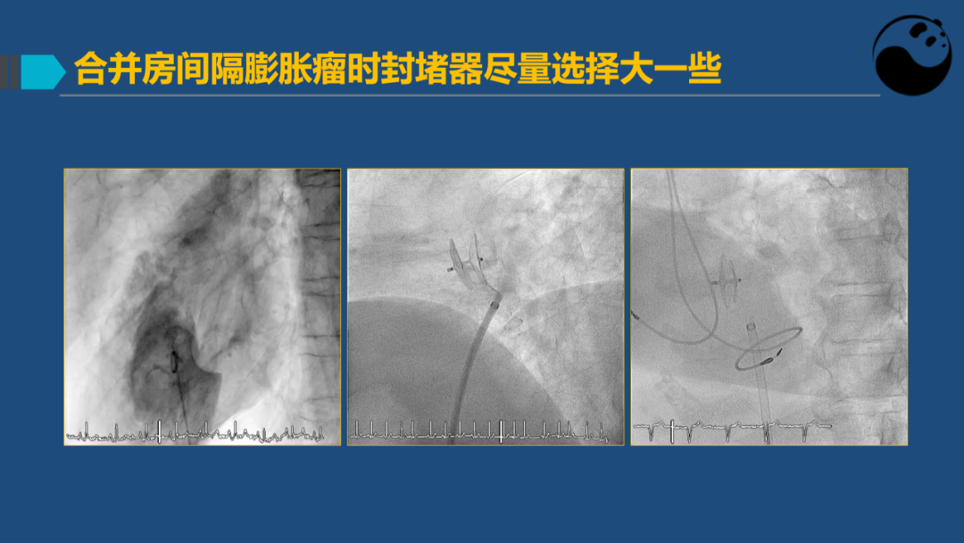 卵圆孔未闭(PFO)介入封堵技巧