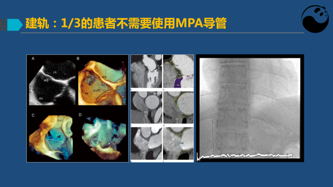 卵圆孔未闭(PFO)介入封堵技巧