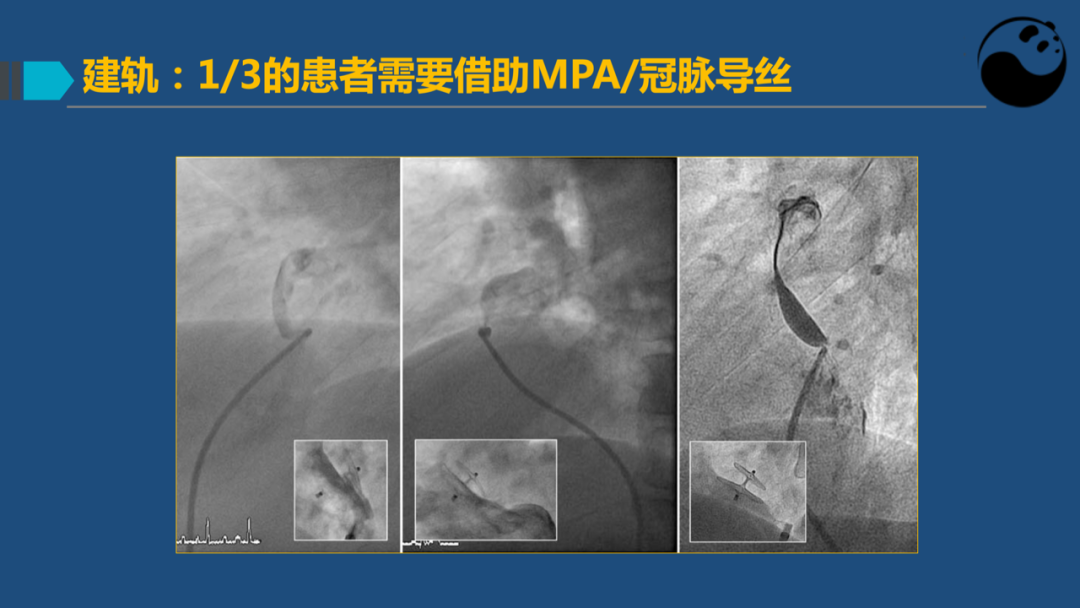 卵圆孔未闭(PFO)介入封堵技巧