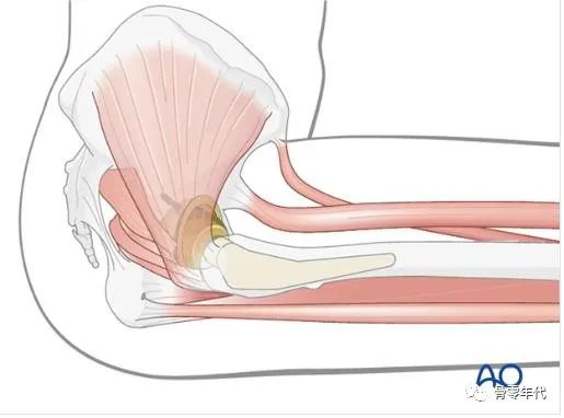 全髋关节翻修术中臀大肌和阔筋膜张肌重建外展肌