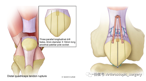 股四头肌腱断裂后哪种手术方法更好呢？