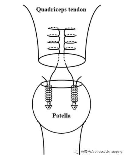 股四头肌腱断裂后哪种手术方法更好呢？