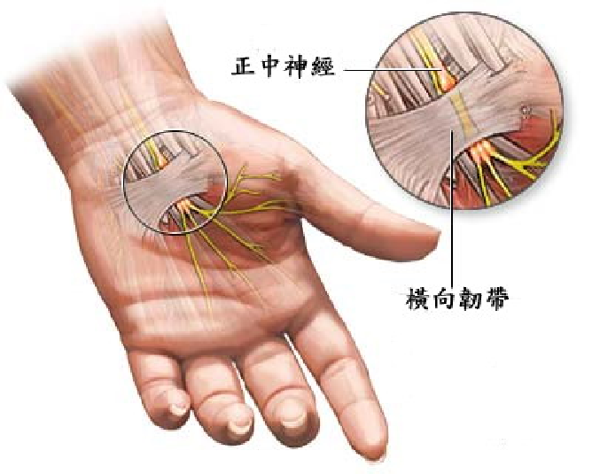 腕管综合征相关的解剖、病因、诊断和治疗