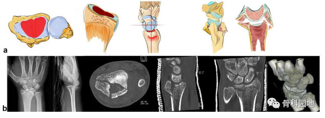 桡骨远端骨折基于损伤原理的分类及治疗方法选择
