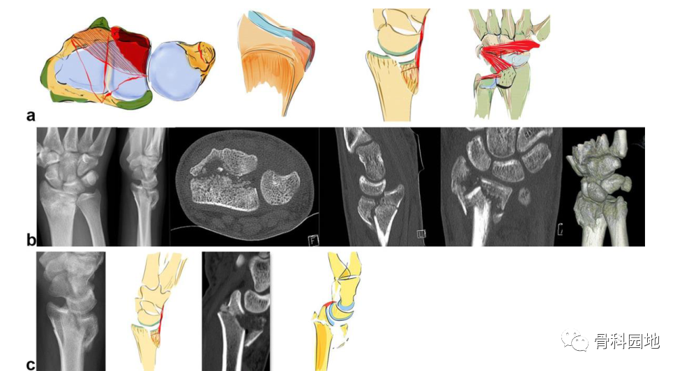 桡骨远端骨折基于损伤原理的分类及治疗方法选择