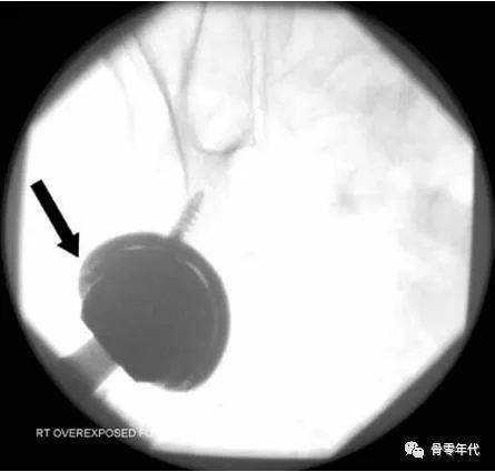 全髋关节置换之陶瓷内衬骨折概述