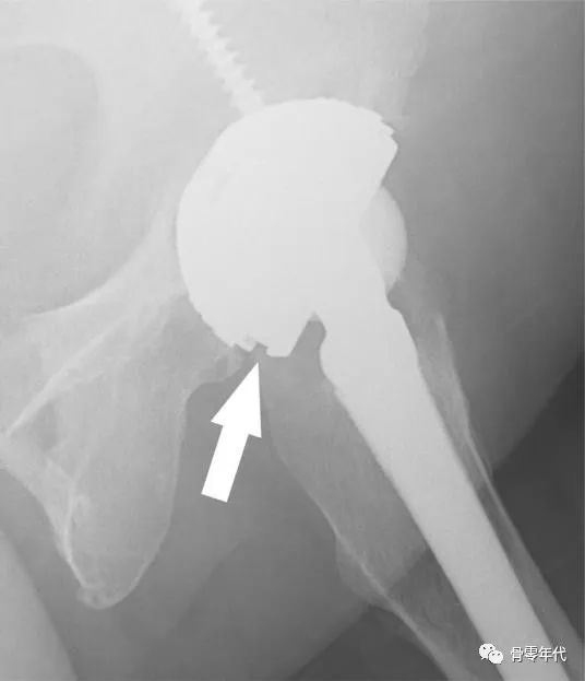 全髋关节置换之陶瓷内衬骨折概述