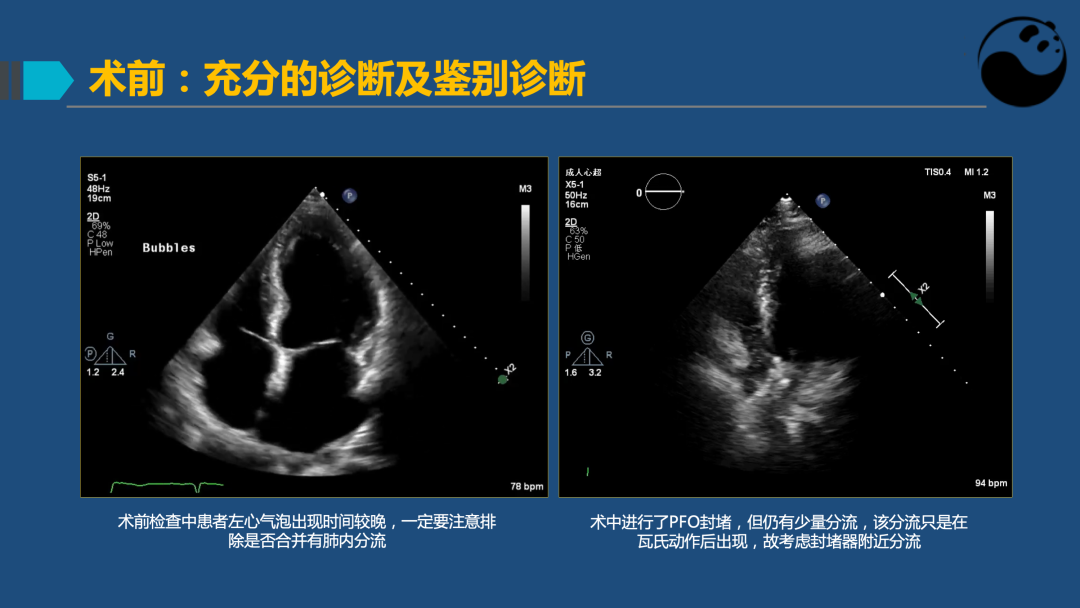 PFO封堵术后残余分流的诊断及处理