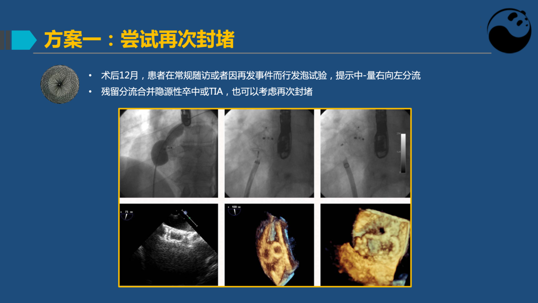 PFO封堵术后残余分流的诊断及处理