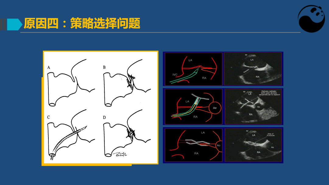 PFO封堵术后残余分流的诊断及处理