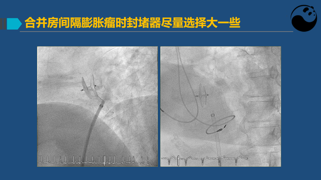 PFO封堵术后残余分流的诊断及处理