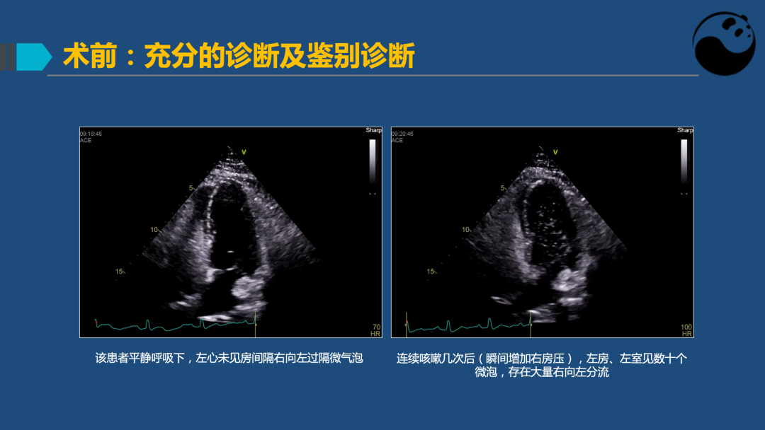 PFO封堵术后残余分流的诊断及处理