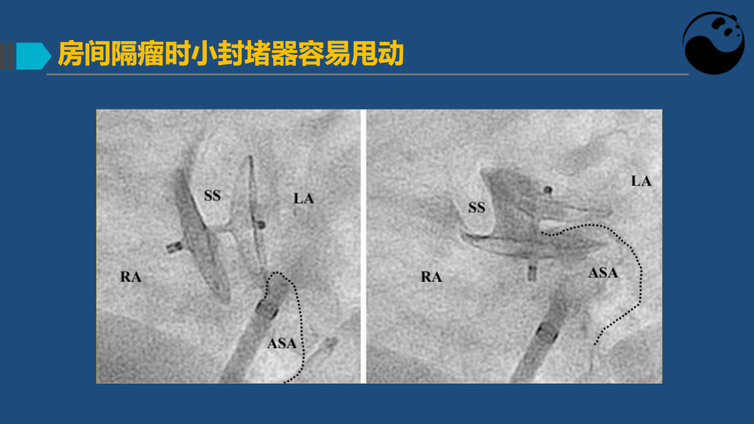 PFO封堵术后残余分流的诊断及处理