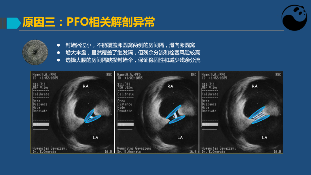 PFO封堵术后残余分流的诊断及处理