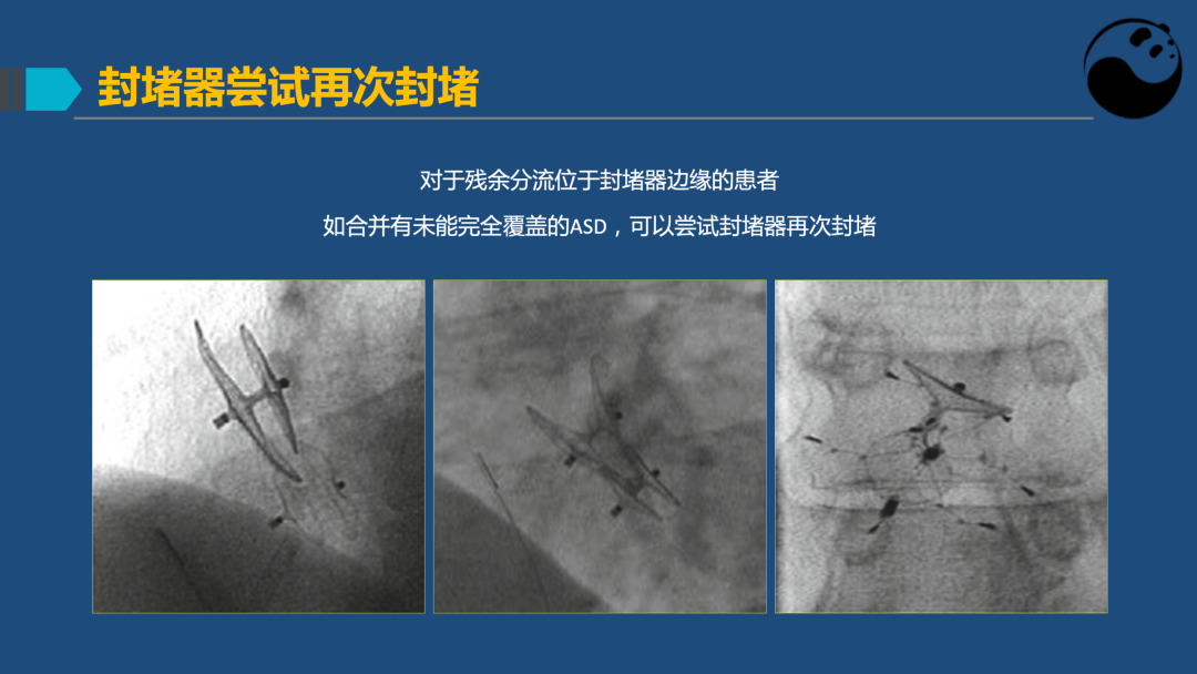 PFO封堵术后残余分流的诊断及处理