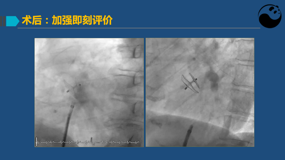 PFO封堵术后残余分流的诊断及处理