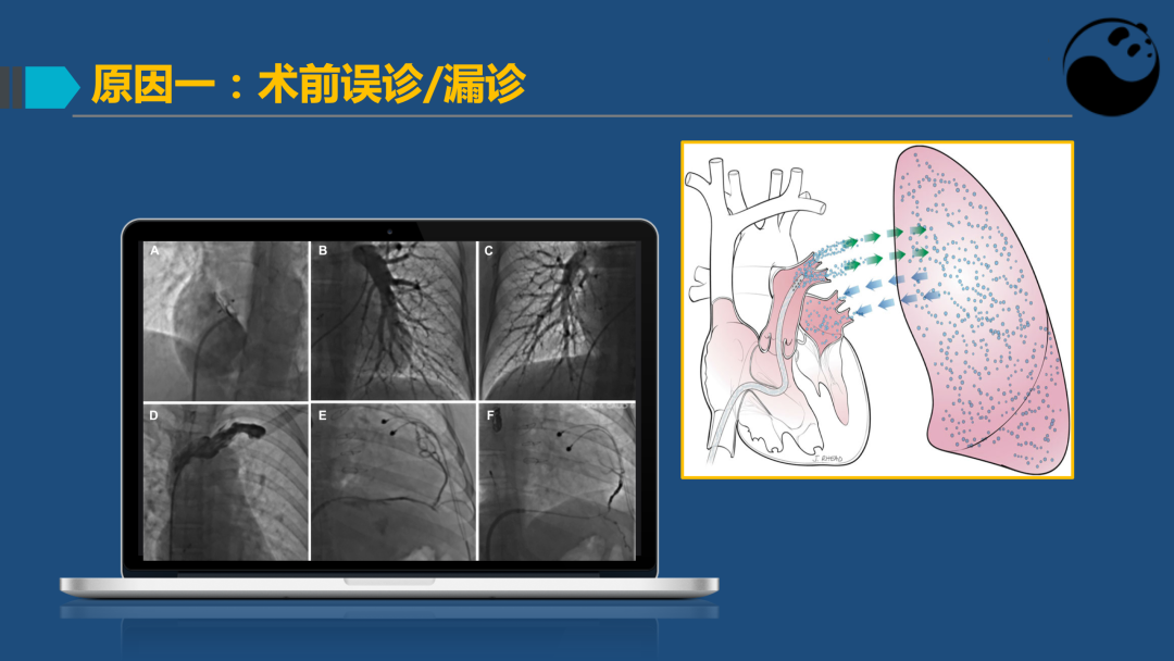 PFO封堵术后残余分流的诊断及处理