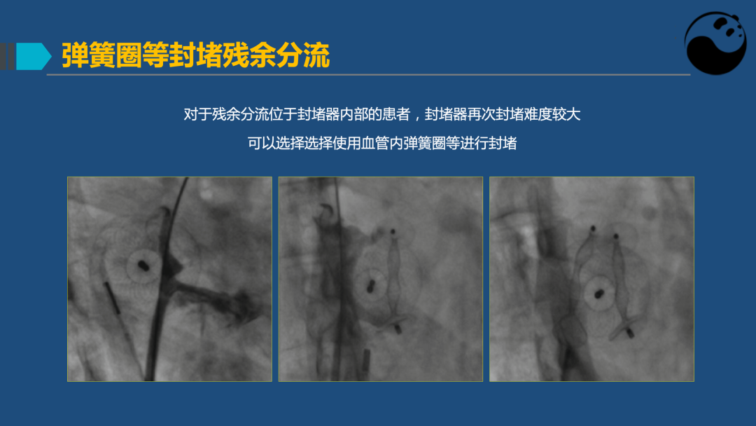 PFO封堵术后残余分流的诊断及处理