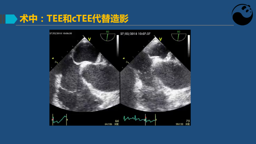 PFO封堵术后残余分流的诊断及处理