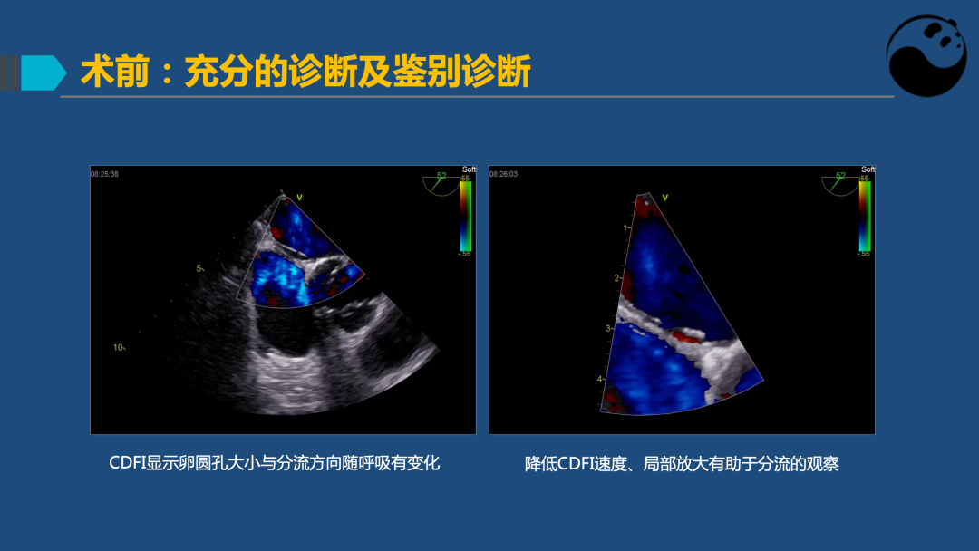 PFO封堵术后残余分流的诊断及处理