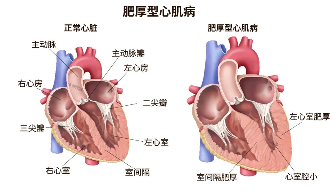 定义更新！2023版中国成人肥厚型心肌病指南发布