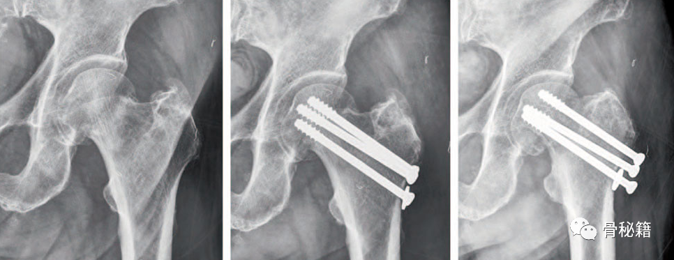 外展坎插型股骨颈骨折切开复位or原位固定？