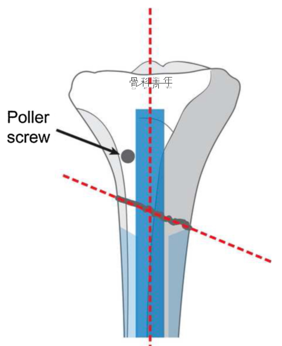 【手术技巧】阻挡钉（Poller钉）的置入技巧及其改良应用