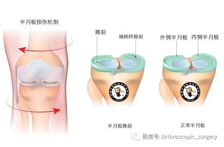 指南与共识｜外侧半月板损伤诊疗专家共识（2022）