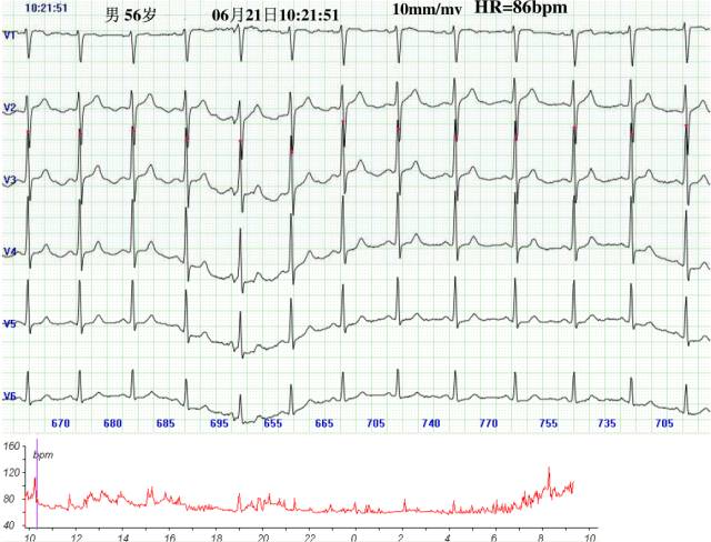 心肌缺血发作时的心电图，8个病例带你看懂！