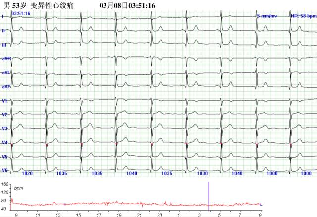 心肌缺血发作时的心电图，8个病例带你看懂！