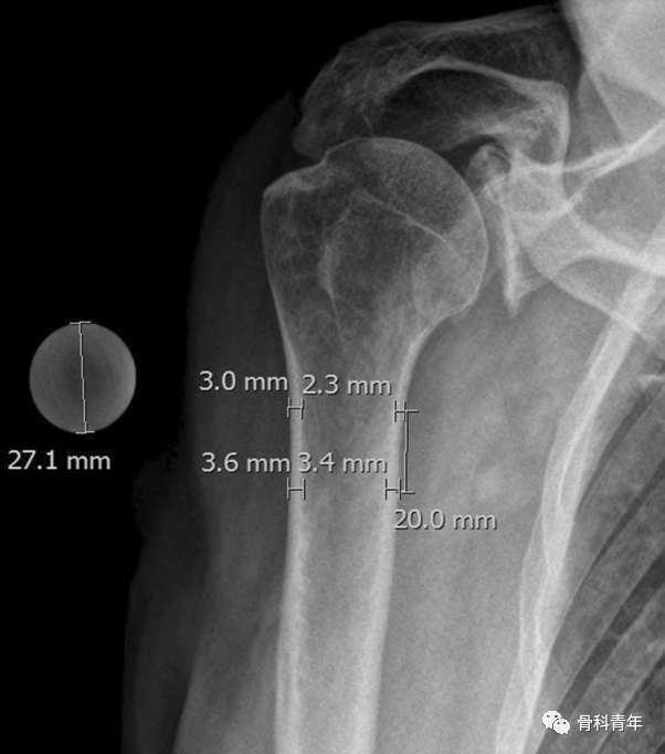 Tingart指数与DTI指数：两个评估肱骨近端骨质疏松的参数