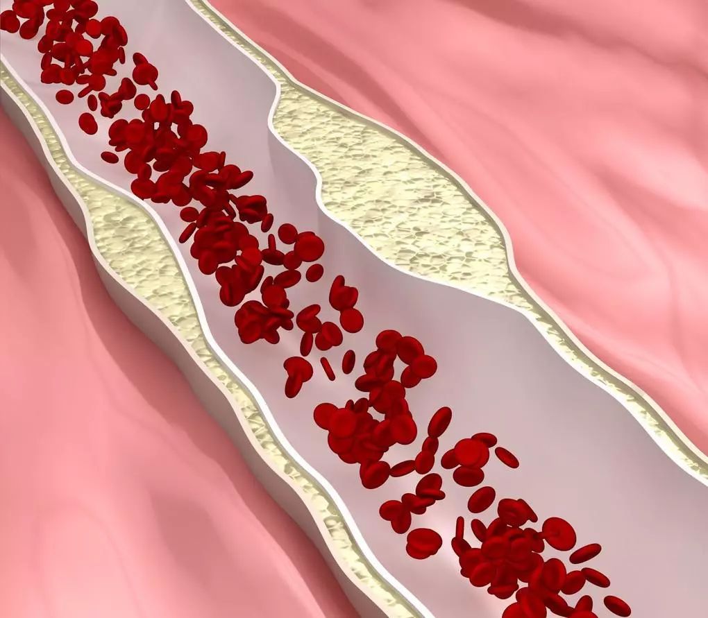 如果有动脉粥样硬化，从哪里可以看出来？预防比治疗更重要