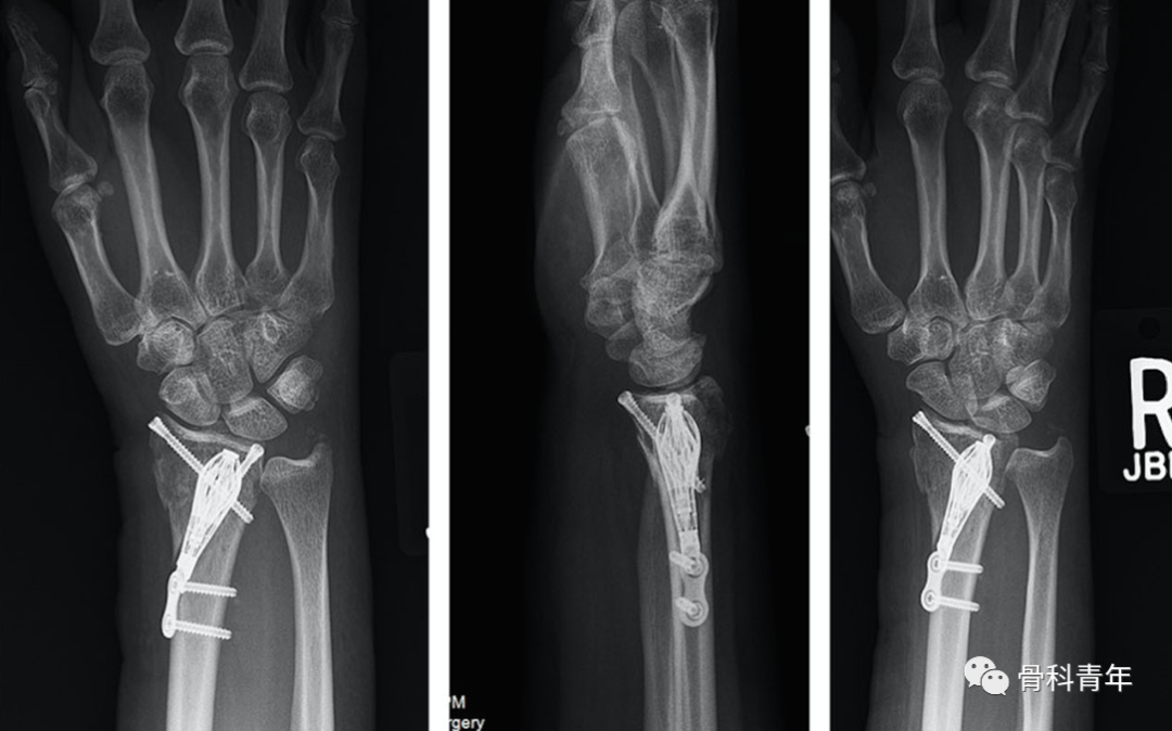 介绍4种桡骨远端骨折的新型内固定技术