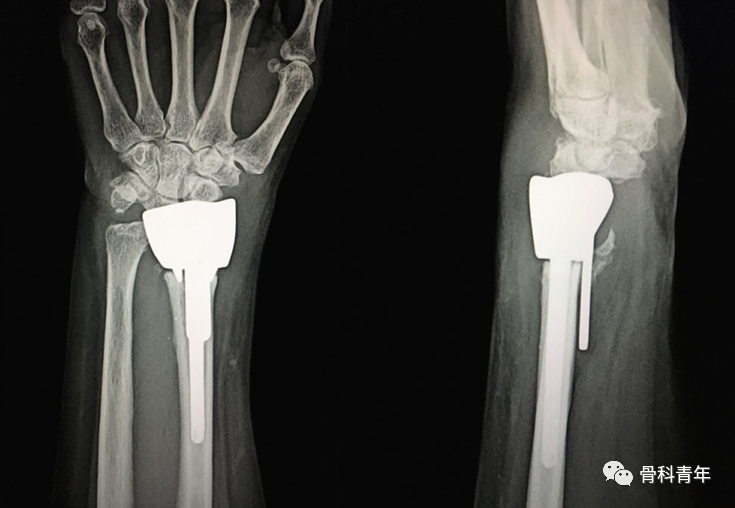 介绍4种桡骨远端骨折的新型内固定技术