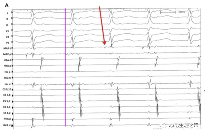 隐匿性结束/结室型AVRT的临床特点和消融