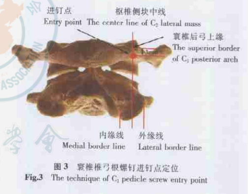 寰椎侧块螺钉内固定技术三维图谱