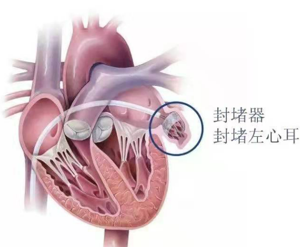 什么是结构性心脏病？其最新诊疗策略是什么？