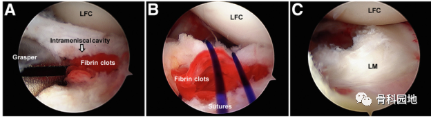 【手术技术】关节镜下外侧半月板囊肿直接减压及使用半月板内减压方法修复半月板