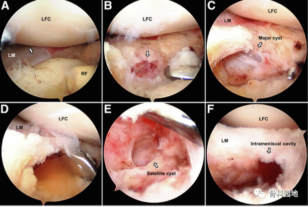 【手术技术】关节镜下外侧半月板囊肿直接减压及使用半月板内减压方法修复半月板