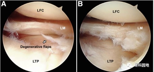【手术技术】关节镜下外侧半月板囊肿直接减压及使用半月板内减压方法修复半月板