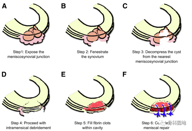 【手术技术】关节镜下外侧半月板囊肿直接减压及使用半月板内减压方法修复半月板