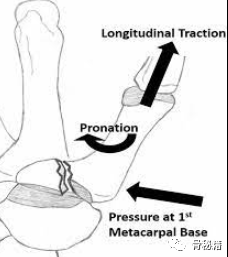 从5个要点认识：贝内特骨折（Bennett