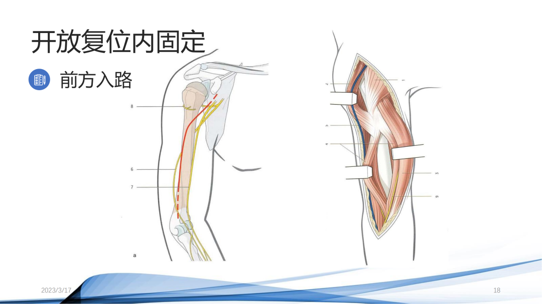 肱骨干骨折：开放复位内固定与髓内钉固定